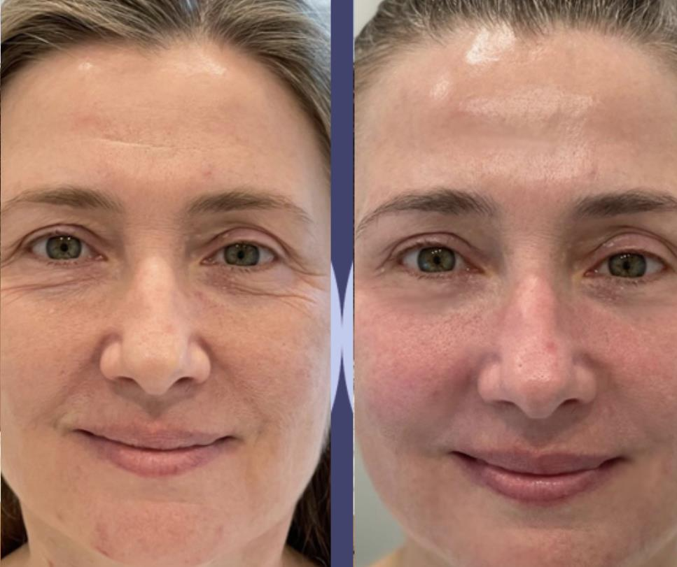 facelift1