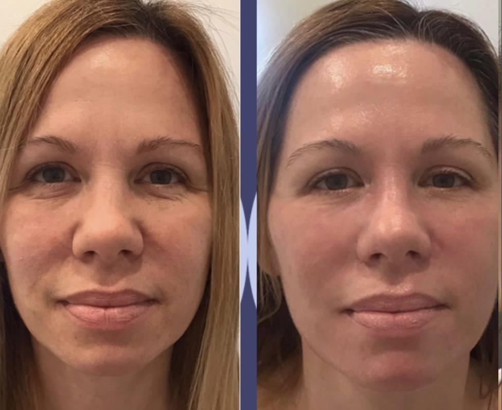 facelift2
