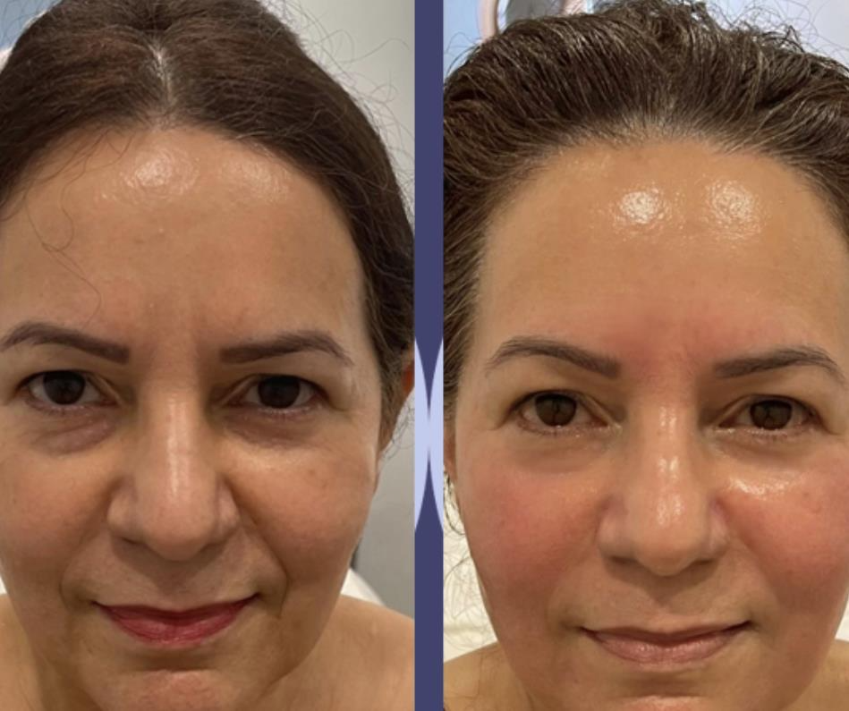 facelift3